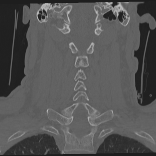 File:Occipital condyle fracture (Radiopaedia 33467-34517 Coronal bone window 40).png