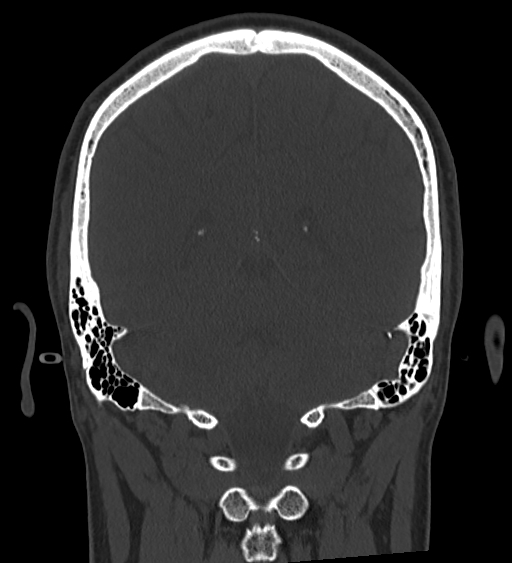 Occipital spur and Currarino type A atlas anomaly (Radiopaedia 87027-103285 Coronal bone window 104).jpg