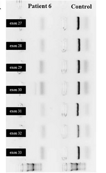 Lack of amplification of PCR products from exon 27 to exon 30 of the PHKA2 gene (versus control)