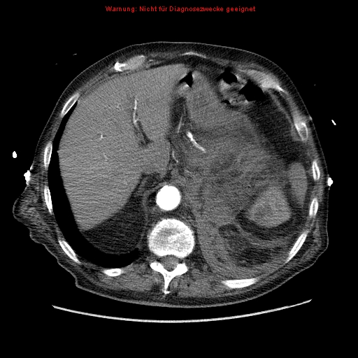 File:Abdominal aortic aneurysm- extremely large, ruptured (Radiopaedia 19882-19921 Axial C+ arterial phase 14).jpg