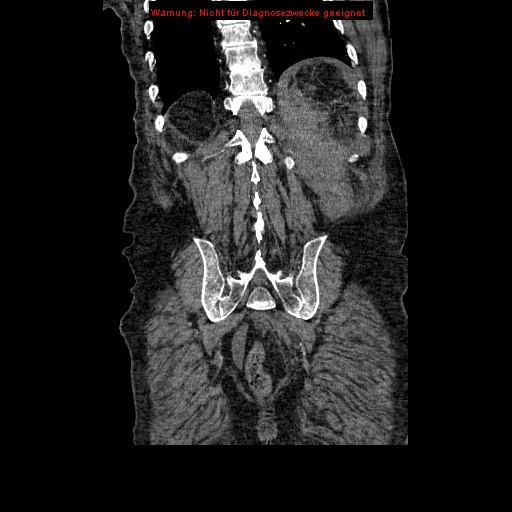 Abdominal aortic aneurysm- extremely large, ruptured (Radiopaedia 19882-19921 Coronal C+ arterial phase 86).jpg