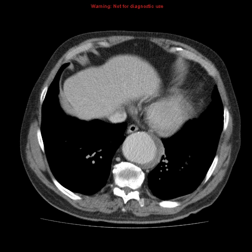 Abdominal aortic aneurysm (Radiopaedia 10122-10660 Axial C+ portal venous phase 6).jpg
