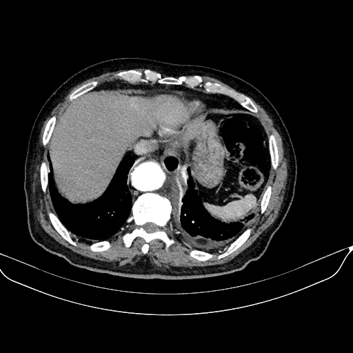 Abdominal aortic aneurysm (Radiopaedia 67117-76452 Axial C+ arterial phase 18).jpg