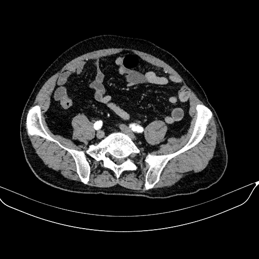 Abdominal aortic aneurysm (Radiopaedia 67117-76452 Axial C+ arterial phase 98).jpg