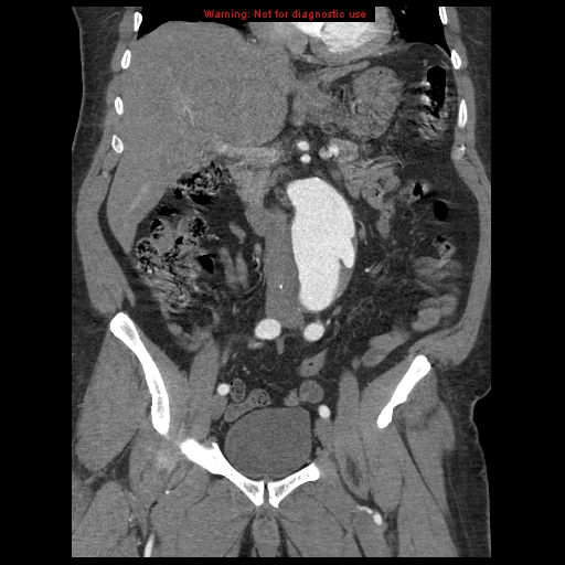File:Abdominal aortic aneurysm (Radiopaedia 8190-9038 Coronal C+ arterial phase 57).jpg