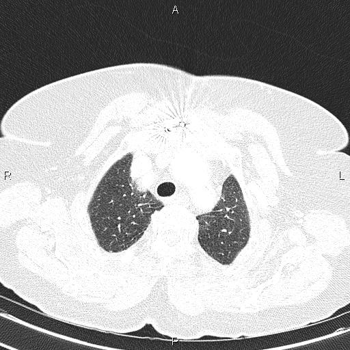 Abdominal aortic aneurysm (Radiopaedia 85063-100606 Axial lung window 17).jpg