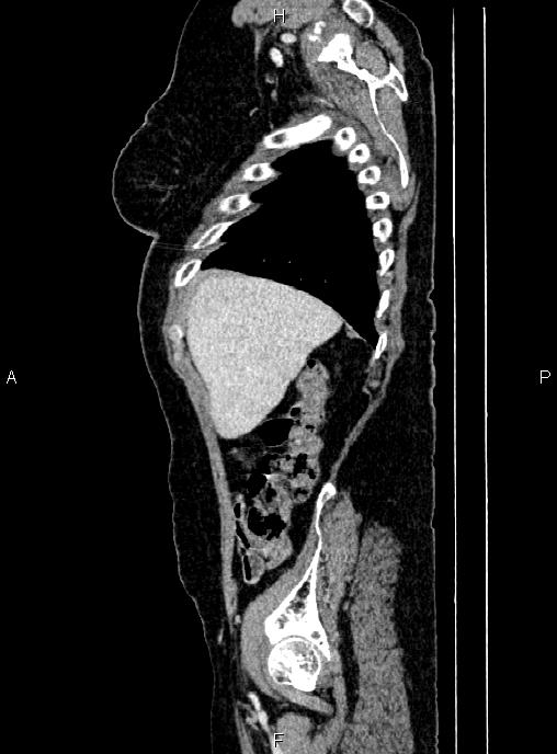 Abdominal aortic aneurysm (Radiopaedia 85063-100606 Sagittal C+ arterial phase 11).jpg