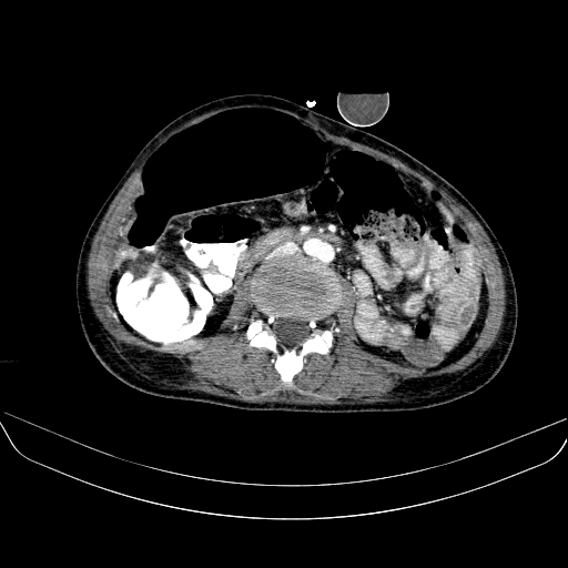 File:Abdominal collection due to previous cecal perforation (Radiopaedia 80831-94320 Axial C+ portal venous phase 109).jpg