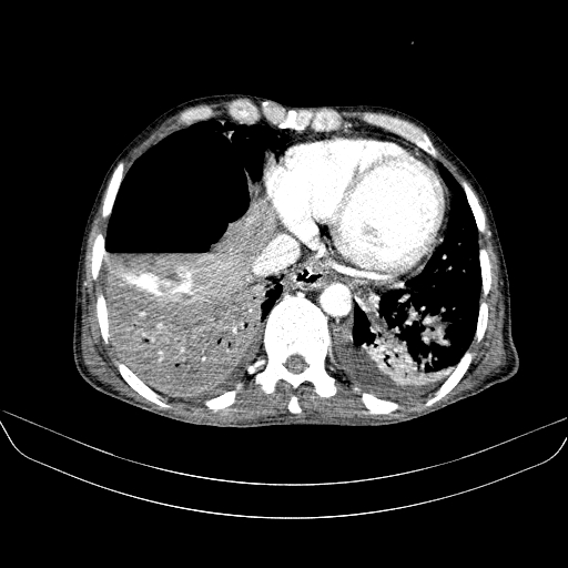 File:Abdominal collection due to previous cecal perforation (Radiopaedia 80831-94320 Axial C+ portal venous phase 14).jpg