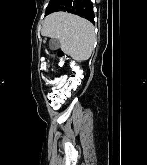 Abdominal lymphoma with sandwich sign (Radiopaedia 84378-99704 Sagittal C+ portal venous phase 10).jpg