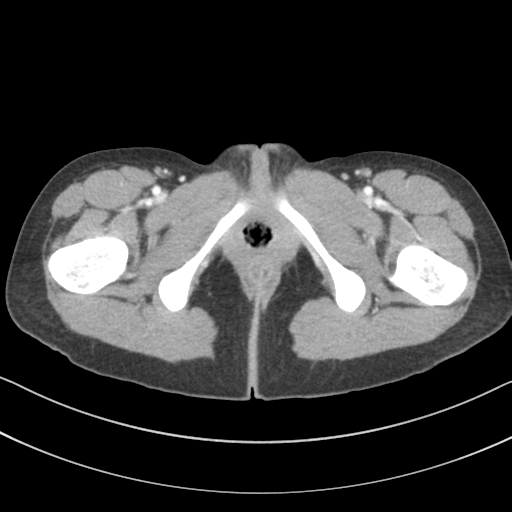 File:Abdominal multi-trauma - devascularised kidney and liver, spleen and pancreatic lacerations (Radiopaedia 34984-36486 Axial C+ portal venous phase 88).png