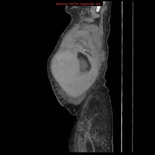 File:Abdominal wall hematoma (Radiopaedia 9427-10112 Sagittal C+ portal venous phase 103).jpg