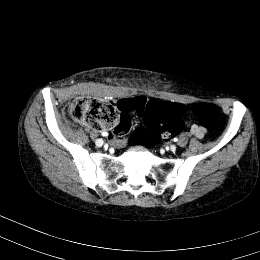 Abdominal wall hematoma with active bleeding (Radiopaedia 83915-99117 Axial renal cortical phase 102).jpg