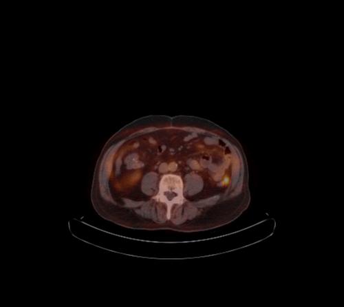 Abdominal wall metastasis from colorectal carcinoma (Radiopaedia 31016-31719 C 55).jpg