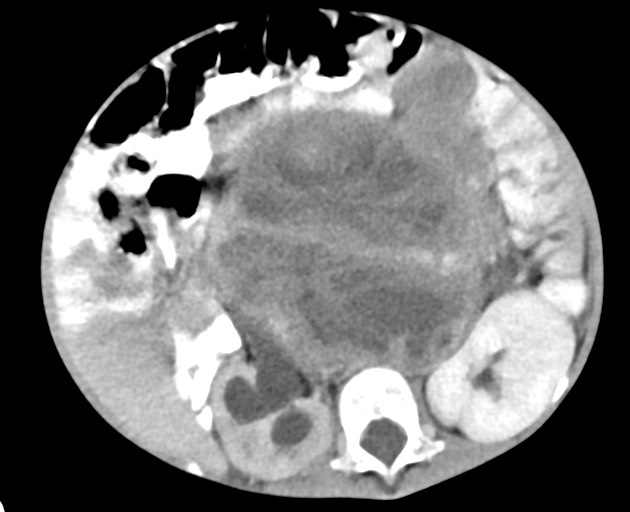 Abdominopelvic rhabdomyosarcoma (Radiopaedia 78356-90984 Axial C+ portal venous phase 83).jpg
