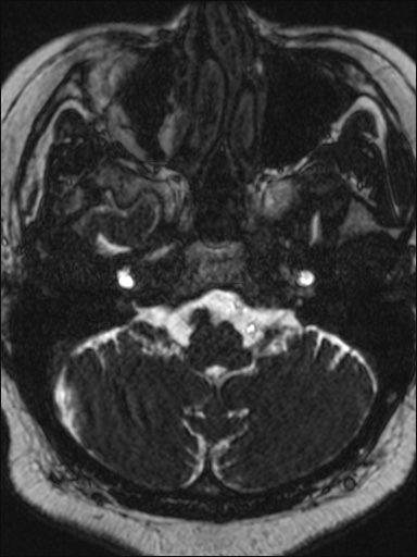 Abducens nerve palsy (Radiopaedia 57084-63976 Axial T2 ciss 3d 14).jpg