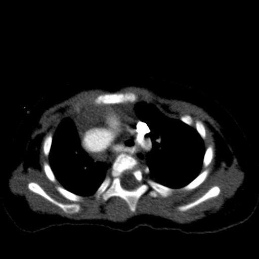 Aberrant left pulmonary artery (pulmonary sling) (Radiopaedia 42323-45435 Axial C+ CTPA 16).jpg