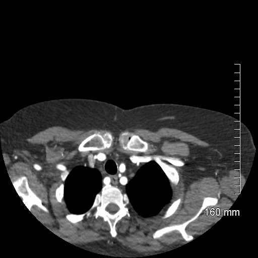 Aberrant right subclavian artery stenosis (Radiopaedia 52656-58670 Axial C+ arterial phase 13).jpg