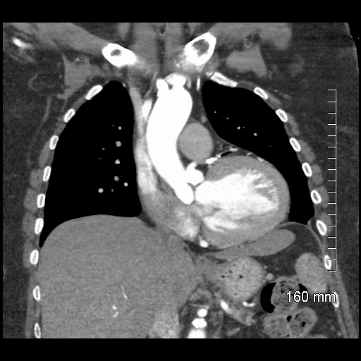 Aberrant right subclavian artery stenosis (Radiopaedia 52656-58670 B 39).jpg