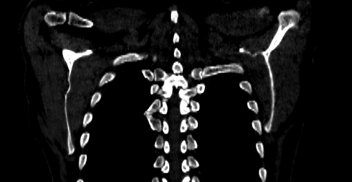 File:Accesory rib joint (Radiopaedia 71987-82452 Coronal bone window 62).jpg