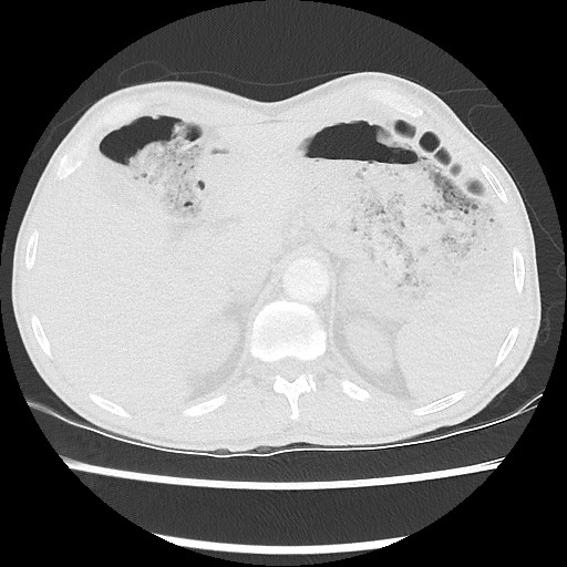 Accessory left horizontal fissure with lingular pneumonia (Radiopaedia 53763-59843 Axial lung window 53).jpg