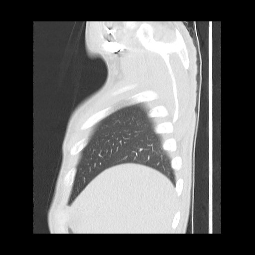Accessory left horizontal fissure with lingular pneumonia (Radiopaedia 53763-59843 Sagittal lung window 12).jpg