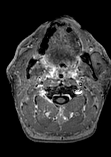 File:Accessory middle cerebral artery (Radiopaedia 73114-83828 Axial T1 C+ 251).jpg
