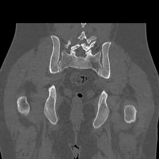 Acetabular and ilial fractures (Radiopaedia 59084-66378 Coronal bone window 40).jpg