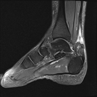 File:Achilles tendon tear (Radiopaedia 77615-89819 Sagittal PD fat sat 9).jpg