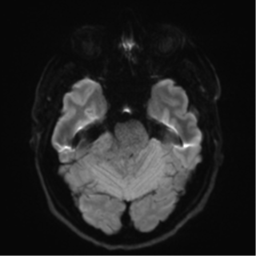 File:Acoustic schwannoma (Radiopaedia 50846-56358 Axial DWI 36).png
