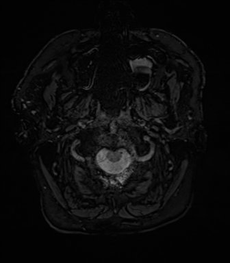 File:Acoustic schwannoma (Radiopaedia 50846-56358 Axial SWI 1).png