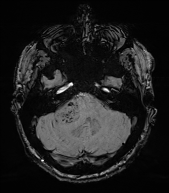 Acoustic schwannoma (Radiopaedia 50846-56358 Axial SWI 23).png
