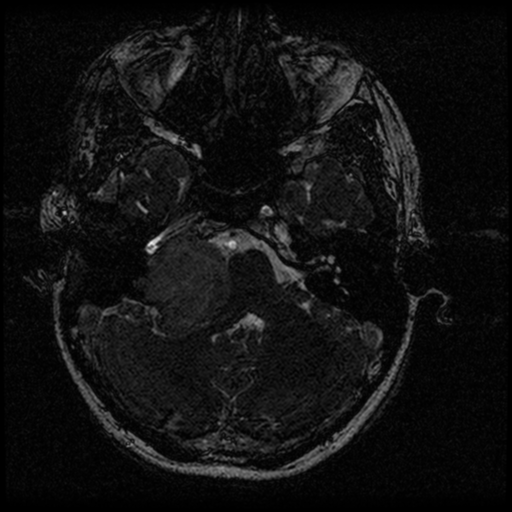Acoustic schwannoma - eroding petrous apex (Radiopaedia 39674-42004 Axial T2 27).png