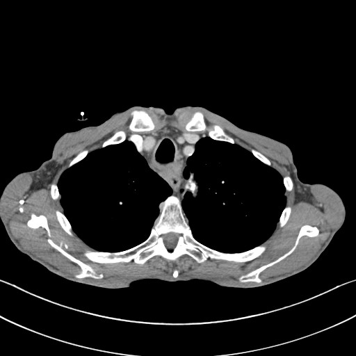 File:Acquired tracheoesophageal fistula (Radiopaedia 57747-65042 Axial C+ portal venous phase 20).jpg