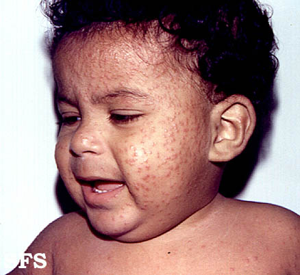File:Acrodermatitis Infantile Papular (Dermatology Atlas 2).jpg