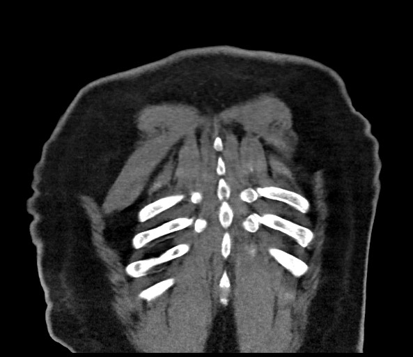 File:Acromioclavicular joint cyst (Radiopaedia 58455-65610 Coronal 104).jpg
