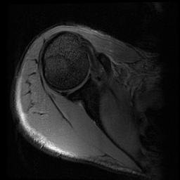 File:Acromioclavicular joint dislocation (Radiopaedia 14218-14076 Axial Gradient Echo 10).jpg