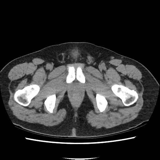 Active colonic bleed on CT (Radiopaedia 49765-55025 Axial non-contrast 86).jpg