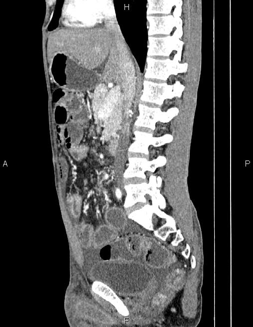 Active crohn disease (Radiopaedia 87133-103397 Sagittal C+ arterial phase 40).jpg