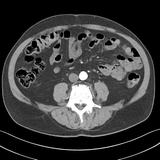 File:Active diverticular hemorrhage (Radiopaedia 39415-41725 Axial C+ arterial phase 37).png