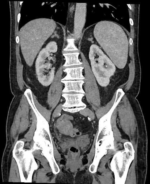 Active lower gastrointestinal bleeding - diverticular (Radiopaedia 61203-69106 Coronal C+ portal venous phase 87).jpg