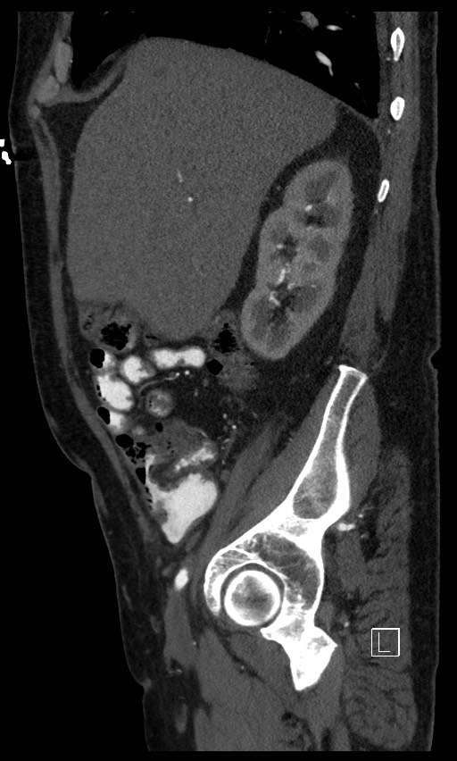 Active lower gastrointestinal bleeding - diverticular (Radiopaedia 61203-69106 Sagittal C+ arterial phase 116).jpg