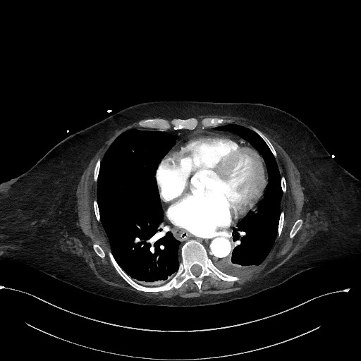 File:Active renal extravasation with large subcapsular and retroperitoneal hemorrhage (Radiopaedia 60975-68796 Axial 213).jpg