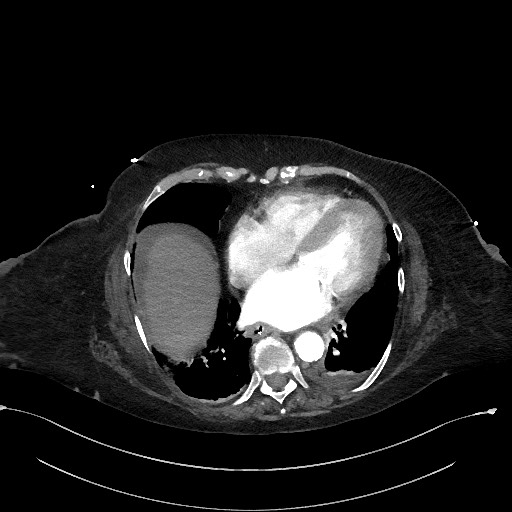 File:Active renal extravasation with large subcapsular and retroperitoneal hemorrhage (Radiopaedia 60975-68796 Axial C+ arterial phase 14).jpg