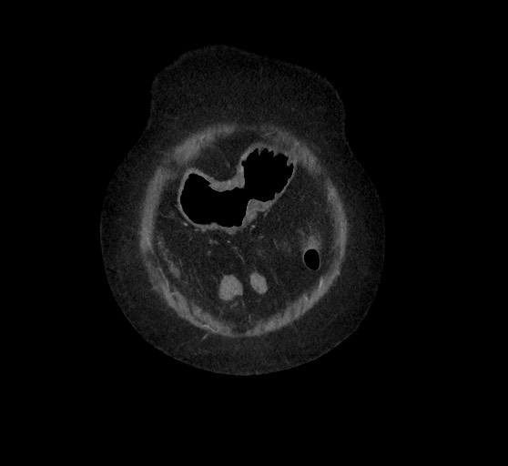 Active renal extravasation with large subcapsular and retroperitoneal hemorrhage (Radiopaedia 60975-68796 Coronal C+ arterial phase 22).jpg