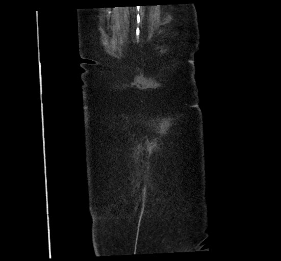 Active renal extravasation with large subcapsular and retroperitoneal hemorrhage (Radiopaedia 60975-68796 Coronal C+ portal venous phase 145).jpg