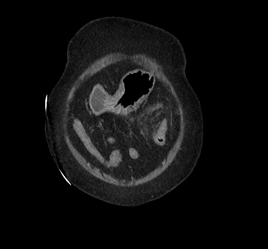 File:Active renal extravasation with large subcapsular and retroperitoneal hemorrhage (Radiopaedia 60975-68796 Coronal C+ portal venous phase 27).jpg