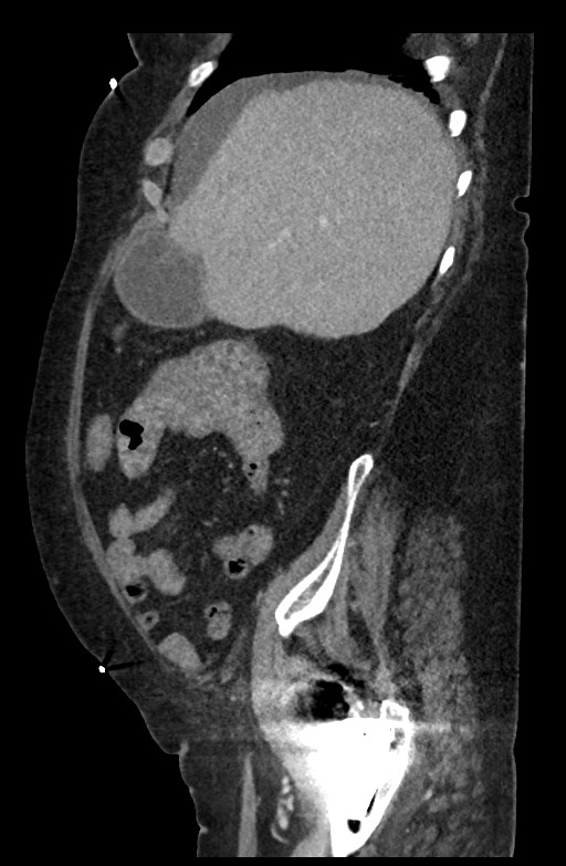 Active renal extravasation with large subcapsular and retroperitoneal hemorrhage (Radiopaedia 60975-68796 Sagittal C+ portal venous phase 168).jpg