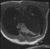 Active right ventricular cardiac sarcoidosis (Radiopaedia 55596-62100 Axial Dynamic perfusion scan MOCO 30).jpg