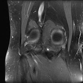 File:Acute-on-chronic transient lateral patellar dislocation with trochlear dysplasia (Radiopaedia 84099-99349 Coronal PD fat sat 12).jpg